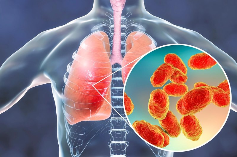 Bệnh Histoplasmosis có thể gây ra viêm phổi