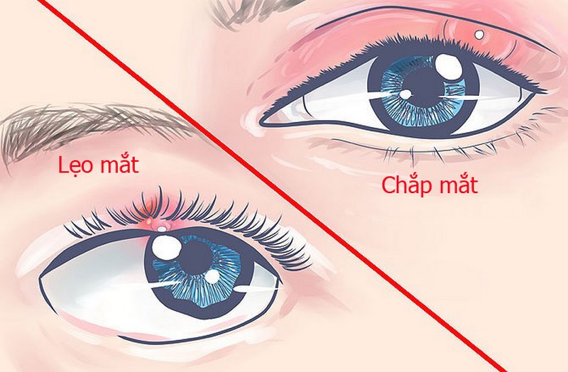 Dấu hiệu và triệu chứng của chấp và lẹo