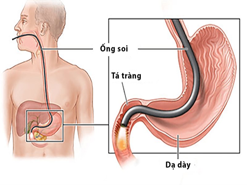 Nội soi thực quản dạ dày tá tràng là phương pháp giúp chẩn đoán và điều trị bệnh