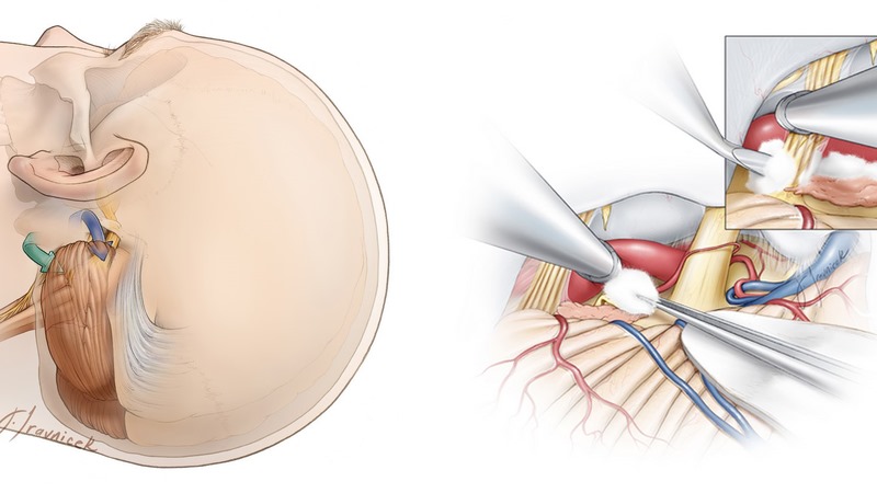 Phẫu thuật giải chèn ép mạch máu thần kinh