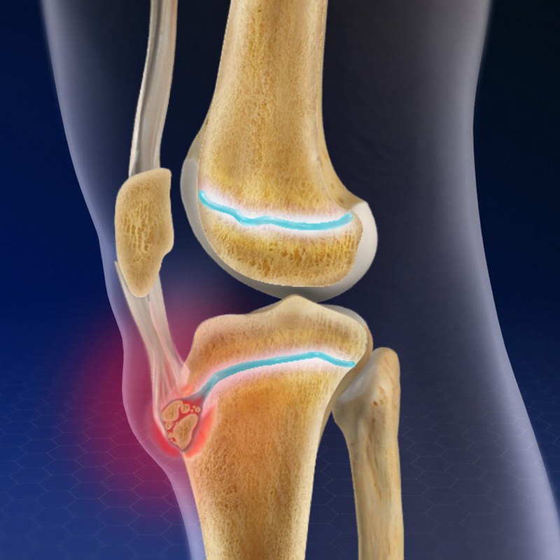 Tìm hiểu chung về bệnh Osgood-Schlatter