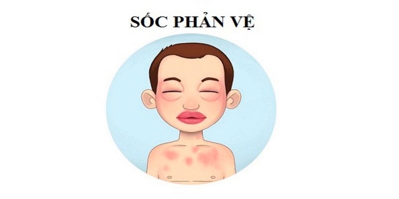 Sốc phản vệ là dạng dị ứng cấp tính