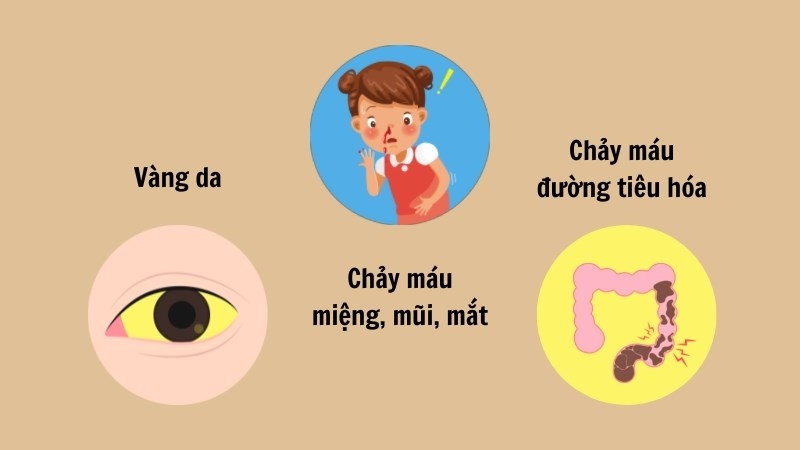 Dấu hiệu và triệu chứng của Sốt vàng