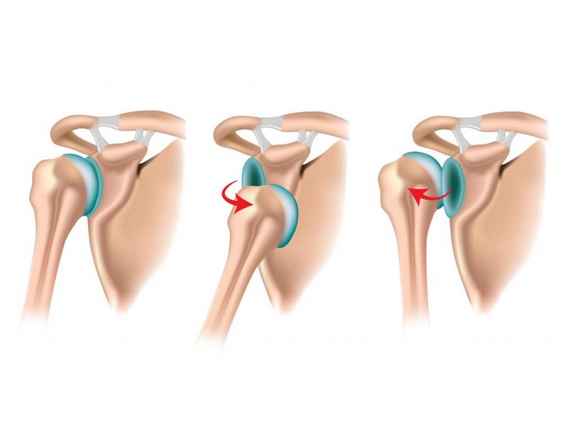 Trật khớp vai về phía trước, phía sau hoặc phía dưới