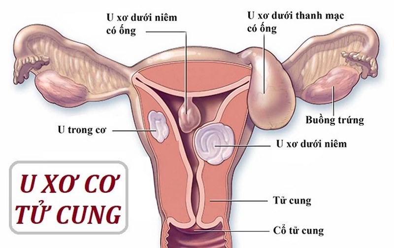 Cần theo dõi sự phát triển của u cơ và các triệu chứng liên quan