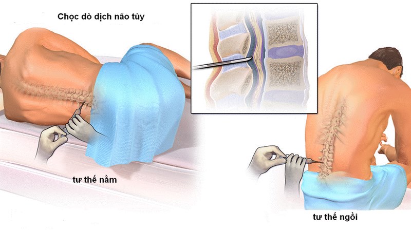 Chọc dò dịch não tủy giúp chẩn đoán viêm tủy cắt ngang