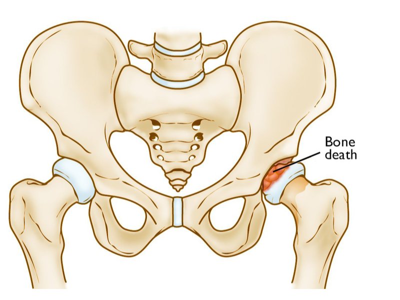 Tổn thương khớp háng ở trẻ em do bệnh Perthes