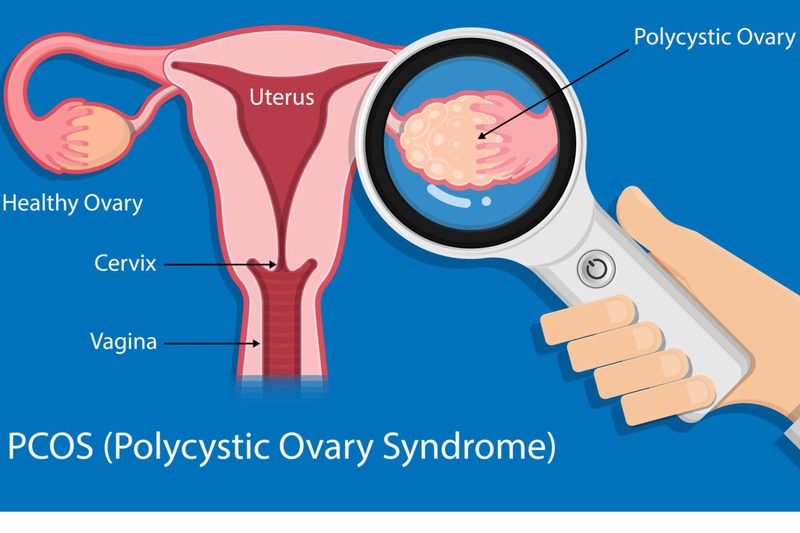 Buồng trứng đa nang là nguyên nhân thường xuyên gây vô sinh thứ phát ở nữ giới