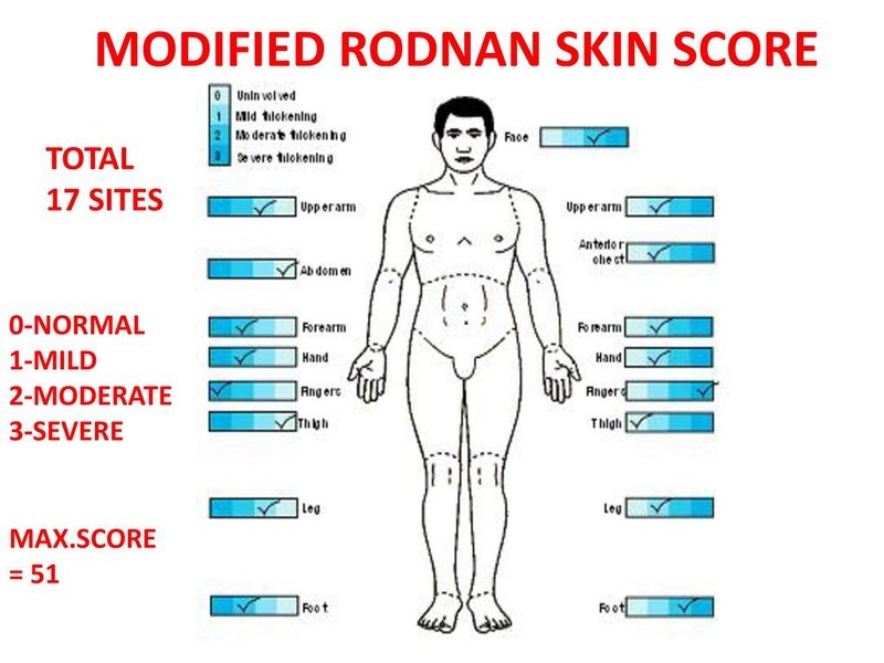 Thang điểm Rodnan để đánh giá độ dày da trong bệnh xơ cứng bì toàn thể