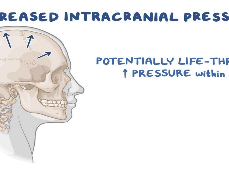 Áp lực nội sọ là gì?