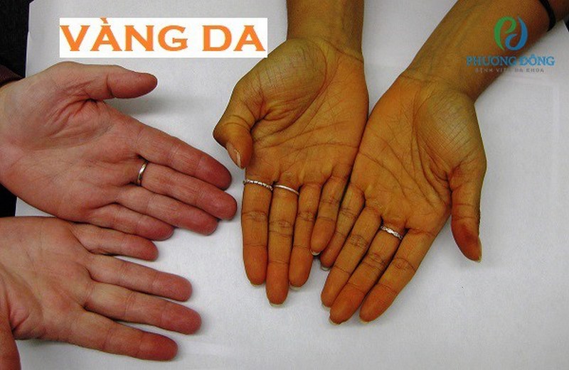 Vàng da là hiện tượng sinh lý do tăng phá hủy hồng cầu