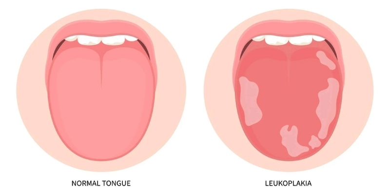 Phát hiện mảng trắng trong miệng gợi ý bạch sản, bạn nên đến gặp bác sĩ