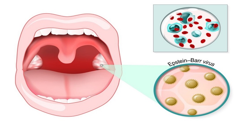 Nhiễm virus Epstein-Barr làm tăng nguy cơ xuất hiện bạch sản