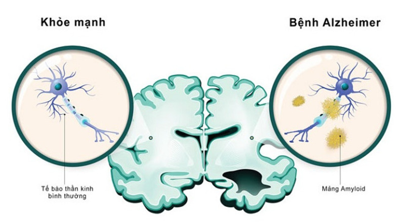 Những dấu hiệu và triệu chứng của bệnh Alzheimer