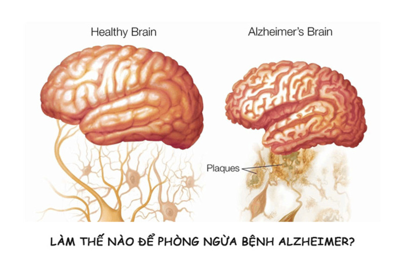 Chế độ sinh hoạt dành cho người mắc bệnh Alzheimer