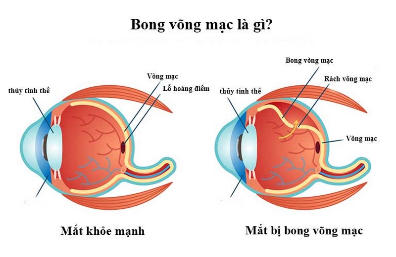 Bong võng mạc là tình trạng dính chặt giữa các tấm lớp mạc trong mắt với nhau