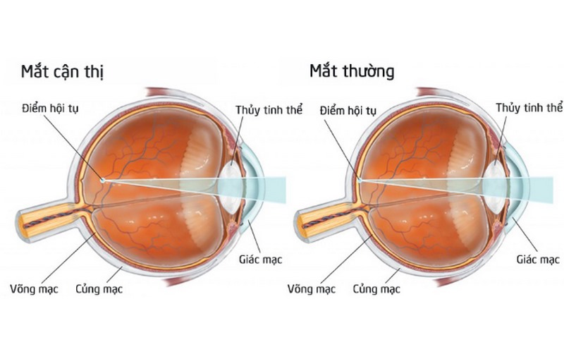 Dấu hiệu và triệu chứng của cận thị