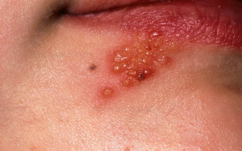 Mụn nước Herpes xuất hiện do bệnh Celiac