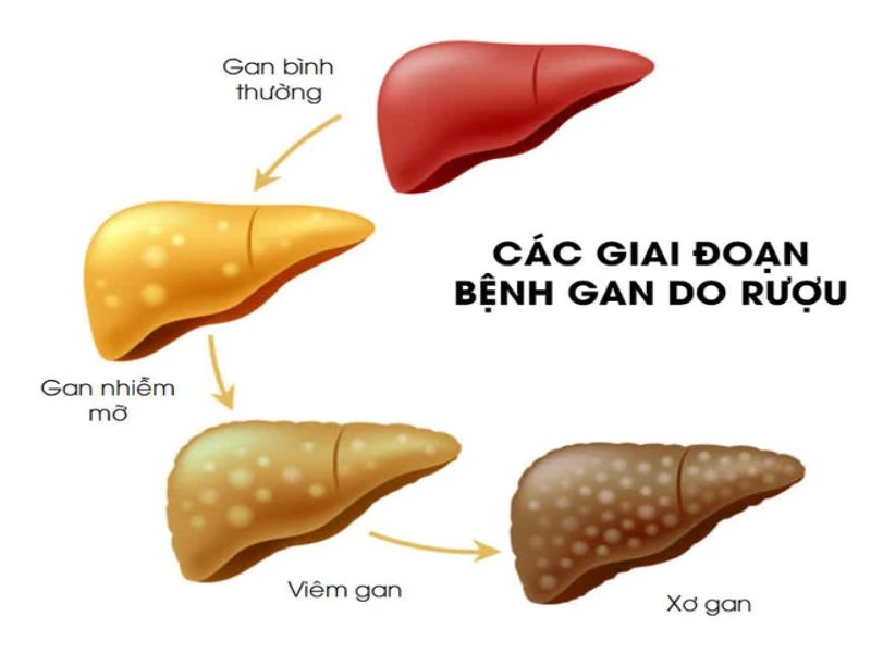 Các giai đoạn bệnh gan do rượu