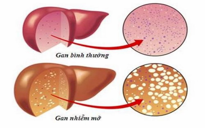 Gan nhiễm mỡ gồm có hai loại: gan nhiễm mỡ không do rượu và gan nhiễm mỡ do rượu