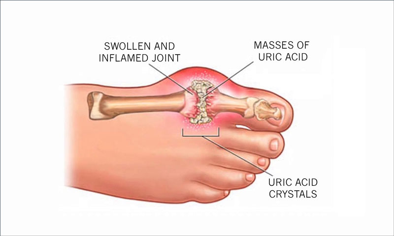 Bệnh gout là dạng viêm khớp sưng đỏ ở các vị trí khớp trên cơ thể khiến bệnh nhân đau dữ dội