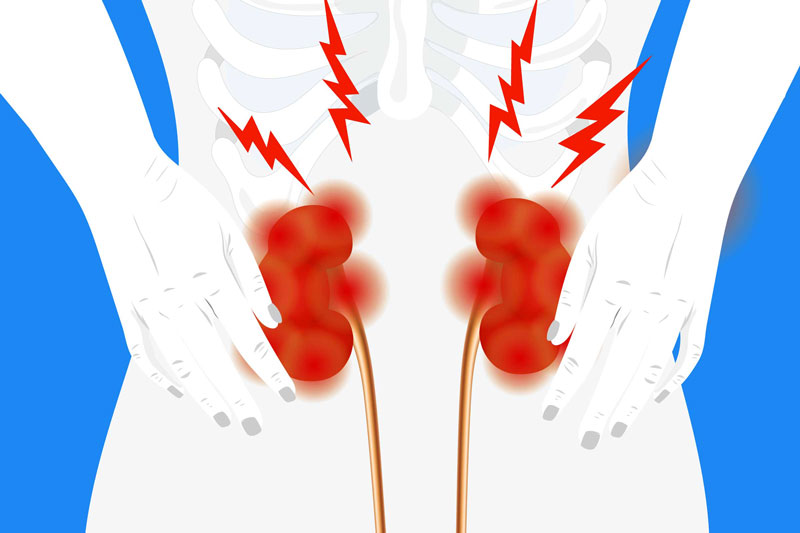 Thận là bệnh lý dẫn đến căn bệnh gout do sự tích tụ axit uric