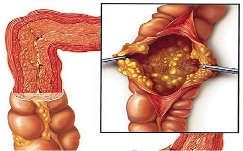 Bệnh lao ruột nằm trong nhóm các bệnh lao ngoài phổi