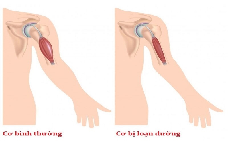 Loạn dưỡng cơ làm teo giảm dần khối lượng cơ trong cơ thể