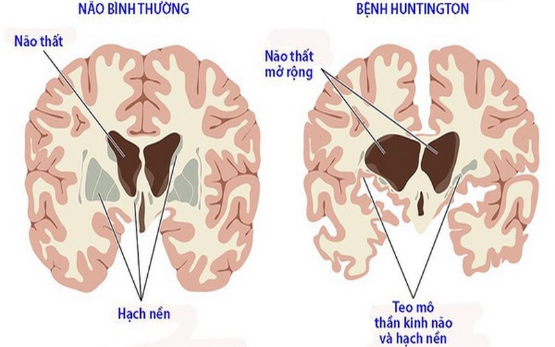 Bệnh múa giật Huntington là một bệnh có tinh chất di truyền