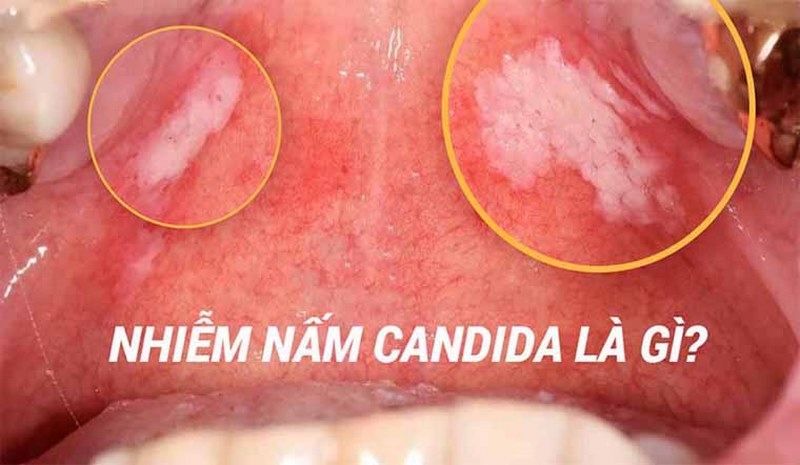 Người có hệ miễn dịch suy giảm dễ mắc bệnh