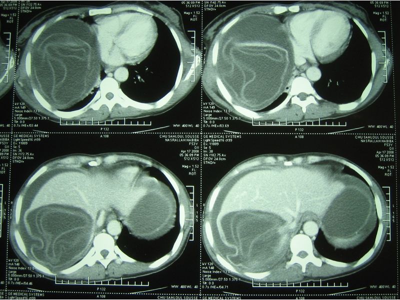 CT scan hay chụp cộng hưởng từ (MRI) để phát hiện ra nang gan