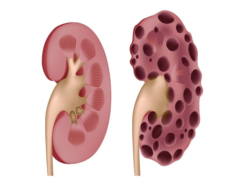 Bệnh nang tủy thận ảnh hưởng trực tiếp đến tủy thận