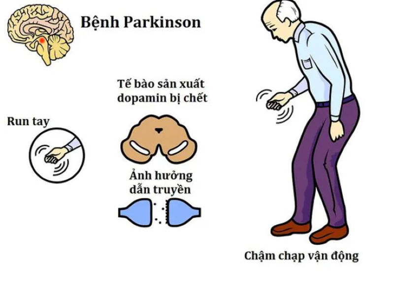 Nguyên nhân dẫn đến bệnh Parkinson