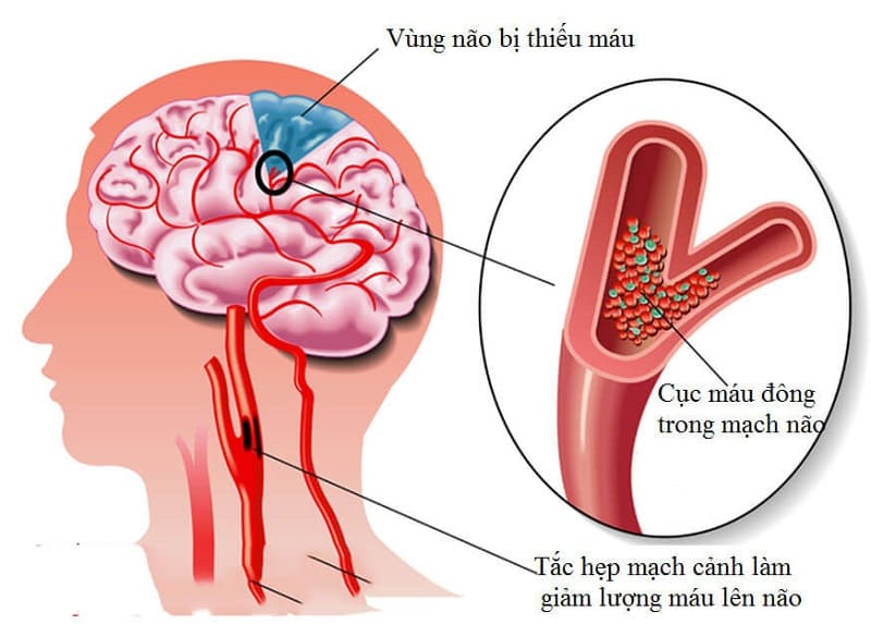 Nguyên nhân dẫn đến bệnh Parkinson thứ phát