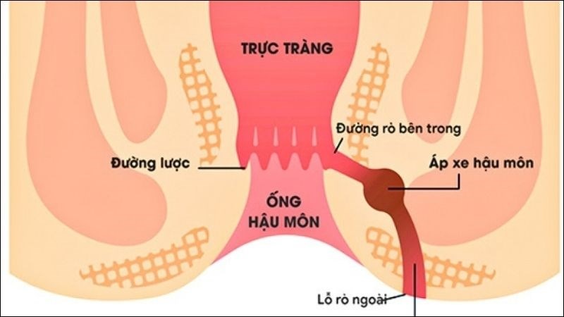 Cách phòng ngừa khe nứt và lỗ rò hậu môn