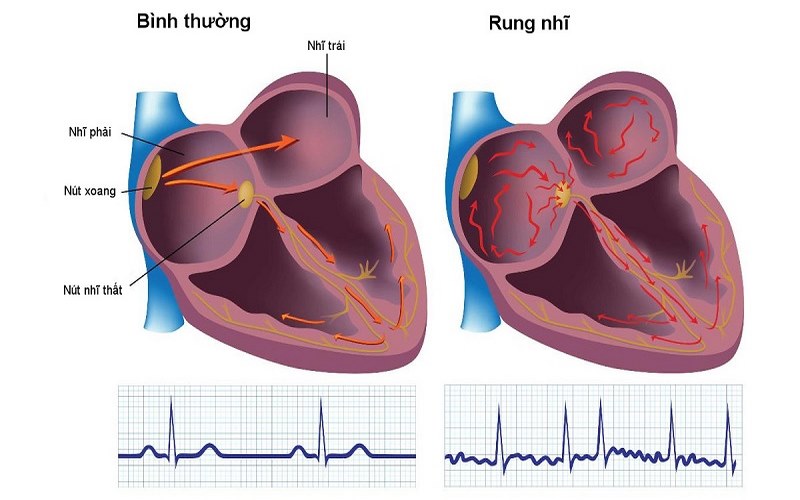 Nhịp tim bị loạn trong bệnh rung nhĩ