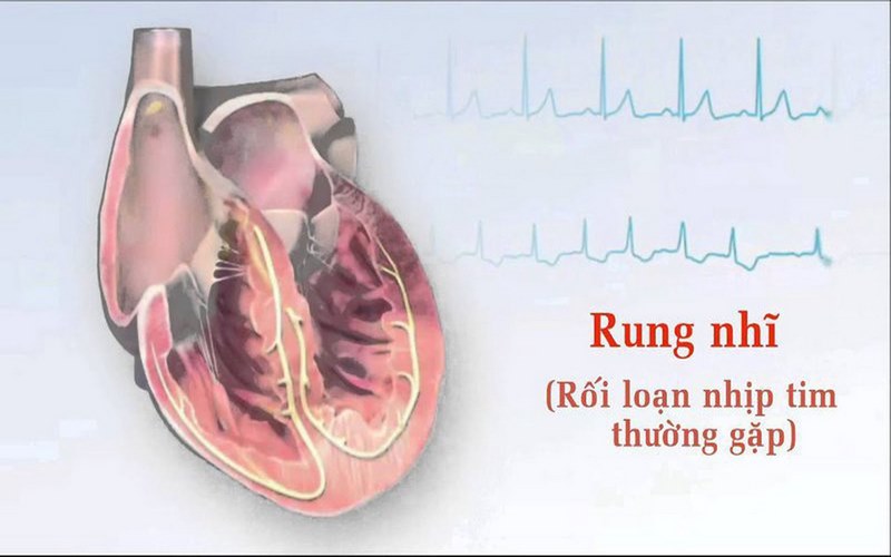 Trên lâm sàng hiện đang chia ra làm nhiều loại rung nhĩ khác nhau