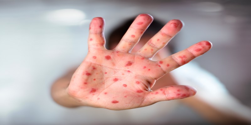 Virus sởi có khả năng lưu lại trong không khí và trên bề mặt trong thời gian dài