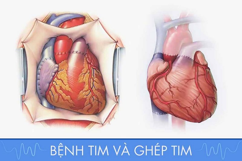 Bạn bị ghép tim và gặp các triệu chứng nguy hiểm sau đây