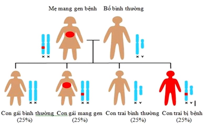 bệnh hầu hết xảy ra ở con trai và di truyền từ mẹ sang con