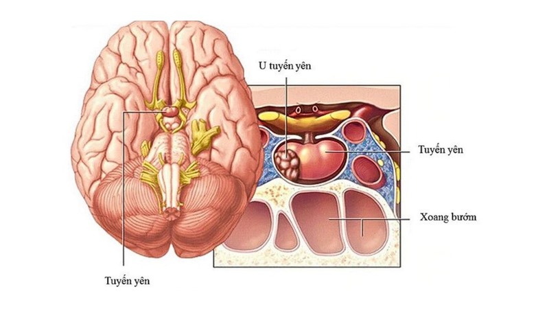 U tuyến yên là một trong những nguyên nhân mắc phải gây ra Lùn tuyến yên