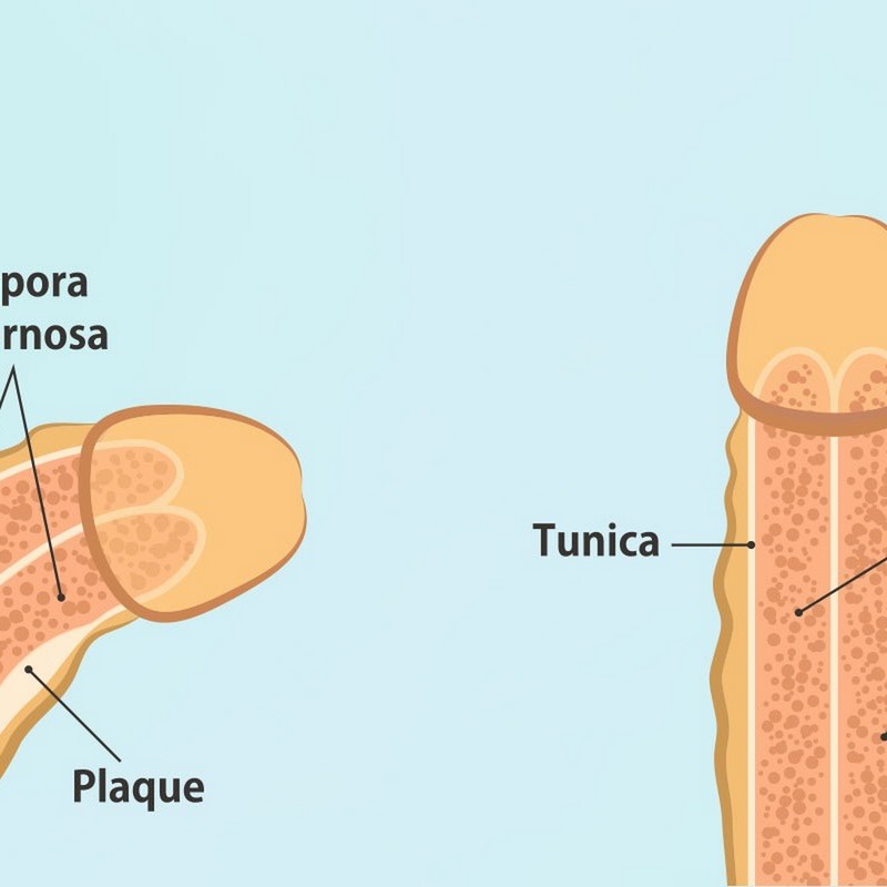 Tránh tình trạng cứng cương quá lâu để ngừa bệnh