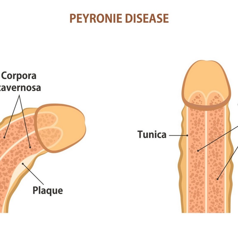 Bệnh Peyronie là một bệnh lý ảnh hưởng đến cơ quan sinh dục nam