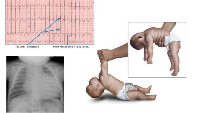 Triệu chứng ở trẻ sơ sinh mắc bệnh Pompe