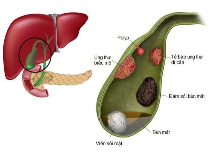 Bệnh nếu không được chữa trị kịp thời sẽ gây ra hậu quả vô cùng nghiêm trọng