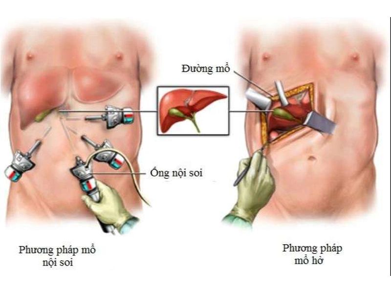 Mổ nội soi là cách chữa trị bệnh sỏi mật bùn hiệu quả hiện nay