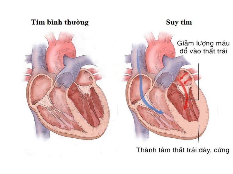 Bệnh suy tim là bệnh lý nguy hiểm