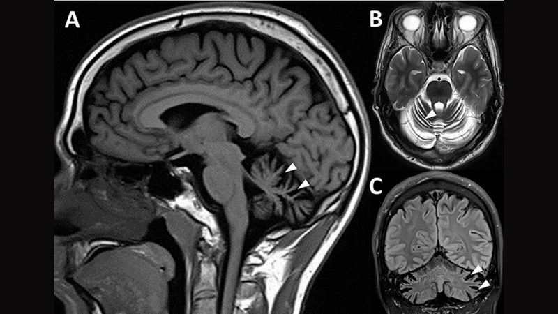 Hình ảnh MRI não của người bệnh Tay-Sachs khởi phát muộn