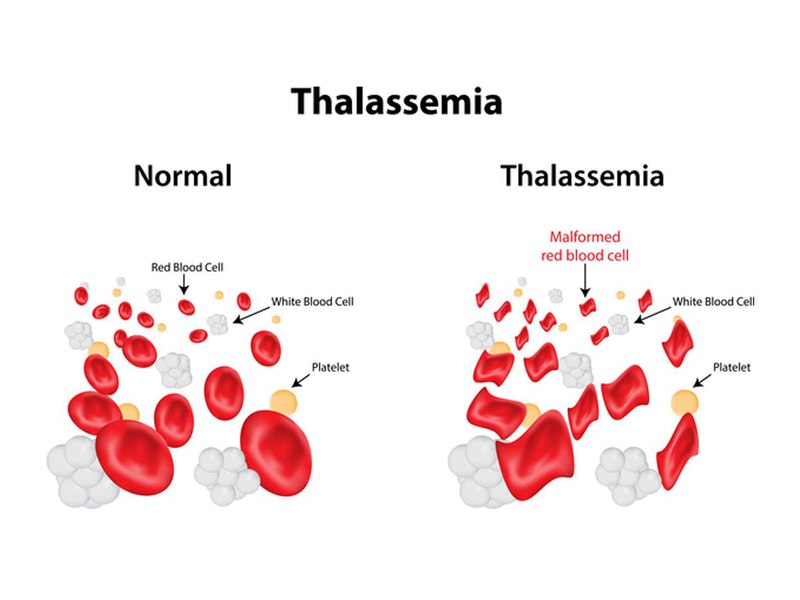 Bệnh Thalassemia có biểu hiện chính là thiếu máu