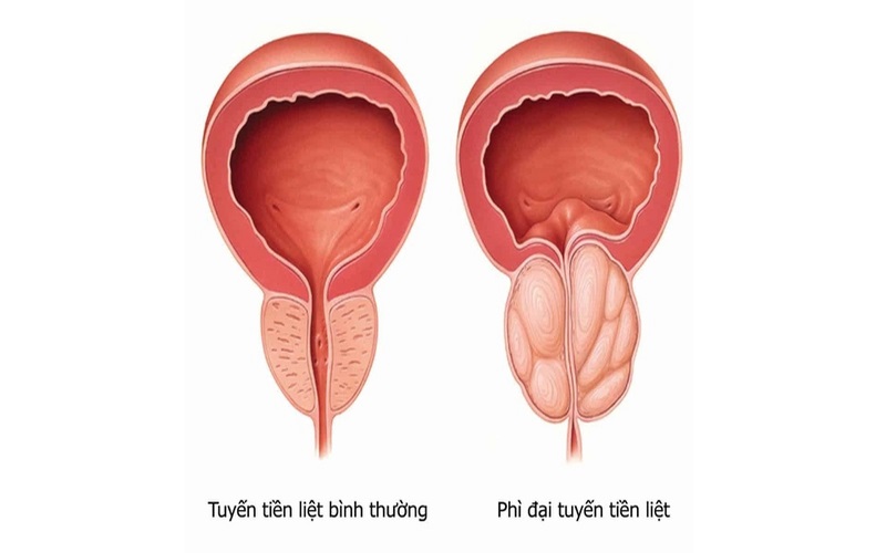 Phì đại tiền liệt tuyến là nguyên nhân phổ biến của bệnh ở nam giới trung niên